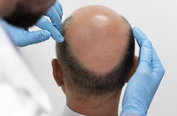 Which is the Best Hair Transplant Clinic in Hyderabad? What You Should Know Before Choosing a Clinic?